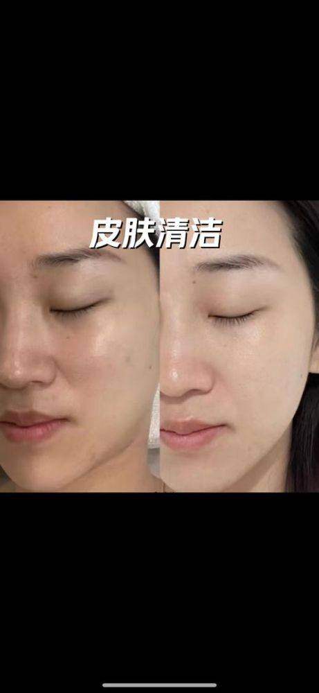医美新手入门，哪些项目风险低成效好，值得一试？水光针、除皱针等6大项目了解下——埋线提升（线提升）