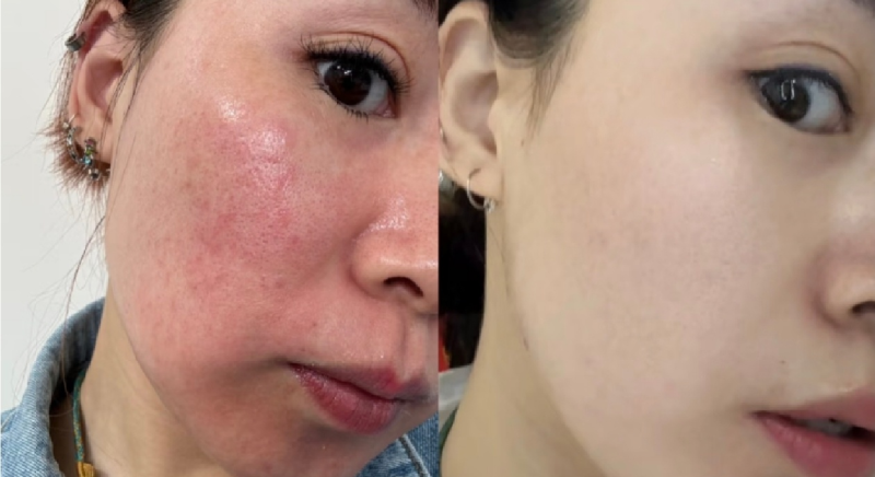 医美新手入门，哪些项目风险低成效好，值得一试？水光针、除皱针等6大项目了解下——除皱针