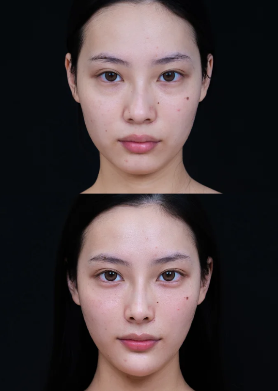 医美新手入门，哪些项目风险低效果好，值得一试？水光针、除皱针等6大项目了解下 