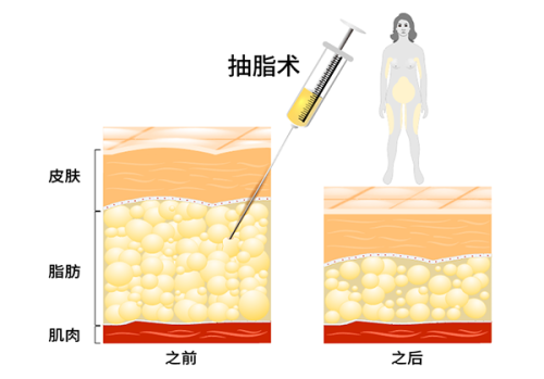 韩国整形医院有中文翻译吗?浪漫江南助力模拟术后成效