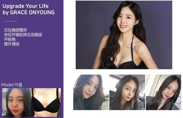 五、韩国格瑞丝噢爱美隆胸项目有什么特点?