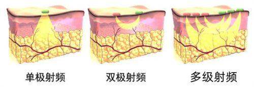 索芙波和超声炮的区别在哪?从成效方面对比