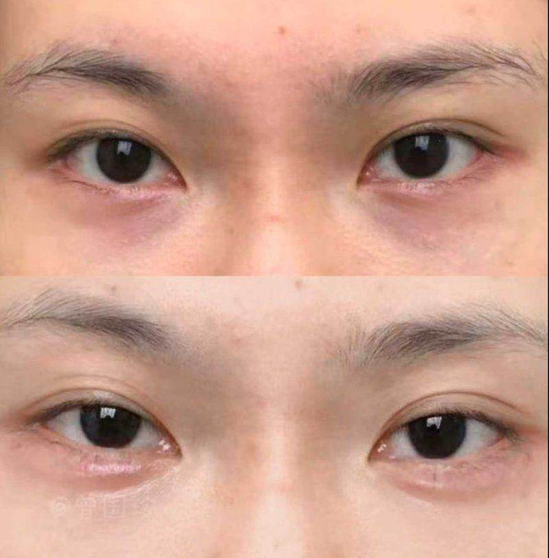 索芙波和超声炮的区别在哪?从适用人群分析