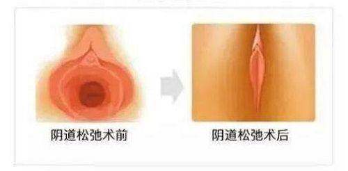 做超声 刀,这些注意事项要牢记!