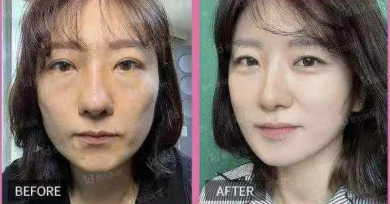 韓國醫美onda避坑指南與隱藏消費預防技巧